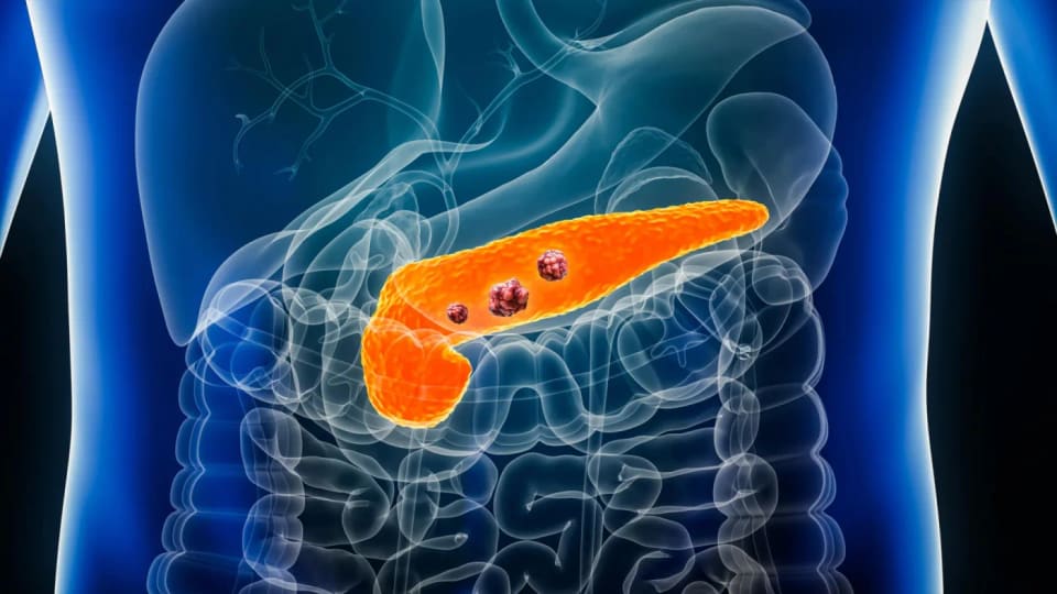 Medical illustration highlighting the pancreas and tumour-like growths inside a human torso.