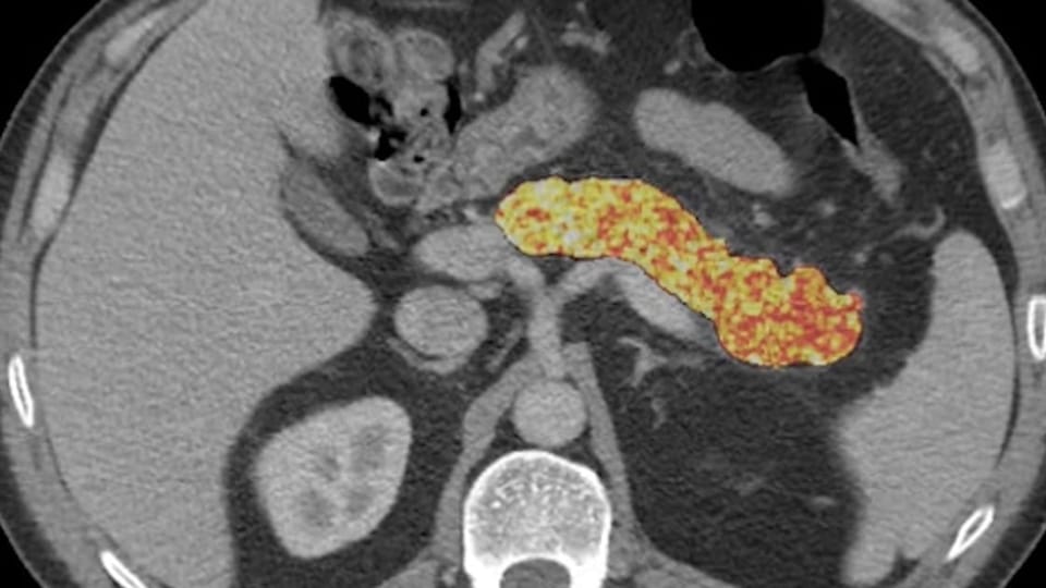 Mayo Clinic AI detects early signs of pancreatic cancer years before diagnosis