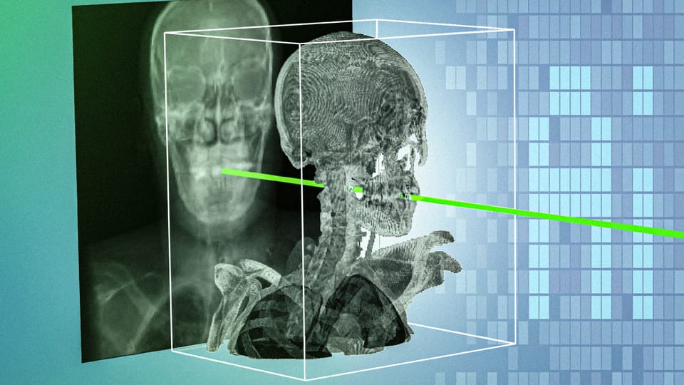 AI system rapidly aligns surgical X-rays with 3D scans for precise navigation